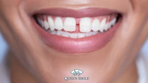 co-nen-boc-rang-su-khong-