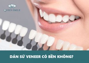 dan-su-veneer-co-ben-khong