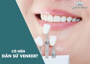 co-nen-dan-su-veneer-khong