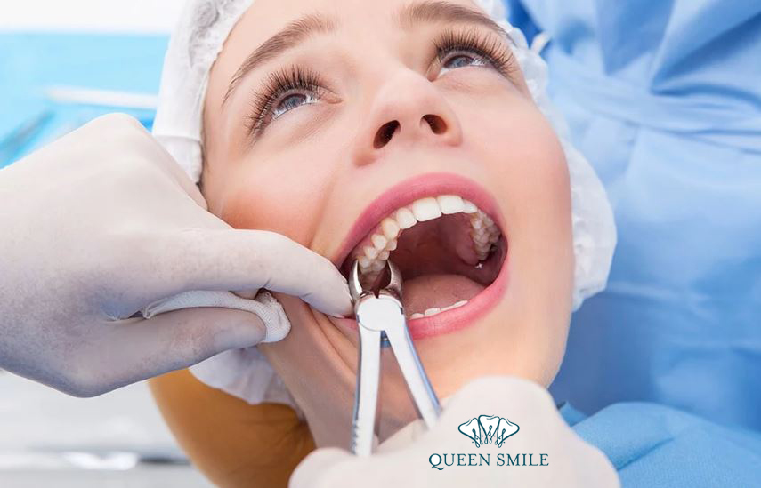 nho-rang-khon-bao-lau-thi-lanh