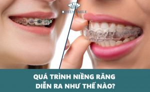 qua-trinh-nieng-rang