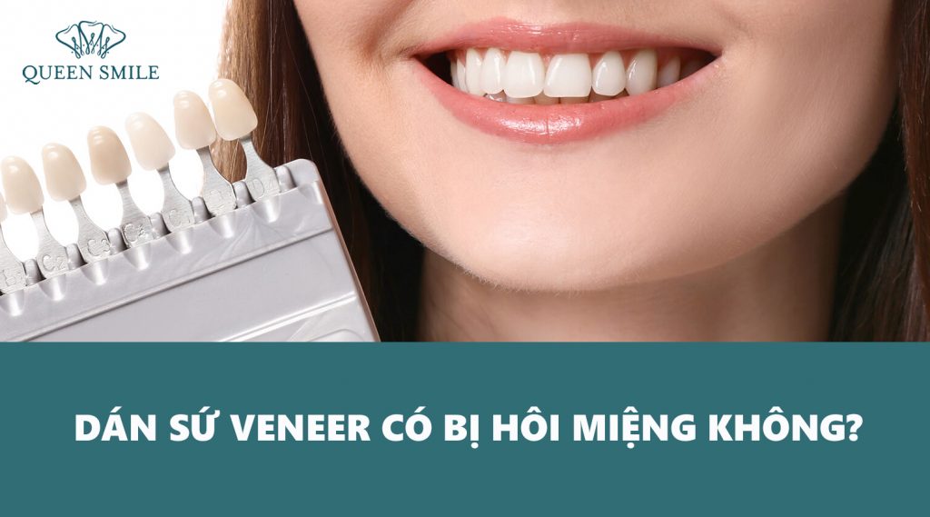 dan-su-veneer-co-bi-hoi-mieng-khong