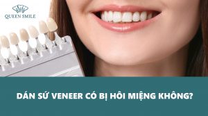 dan-su-veneer-co-bi-hoi-mieng-khong