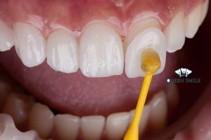 cac-buoc-dan-su-veneer