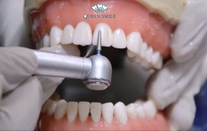 dan-su-veneer-co-mai-rang-khong