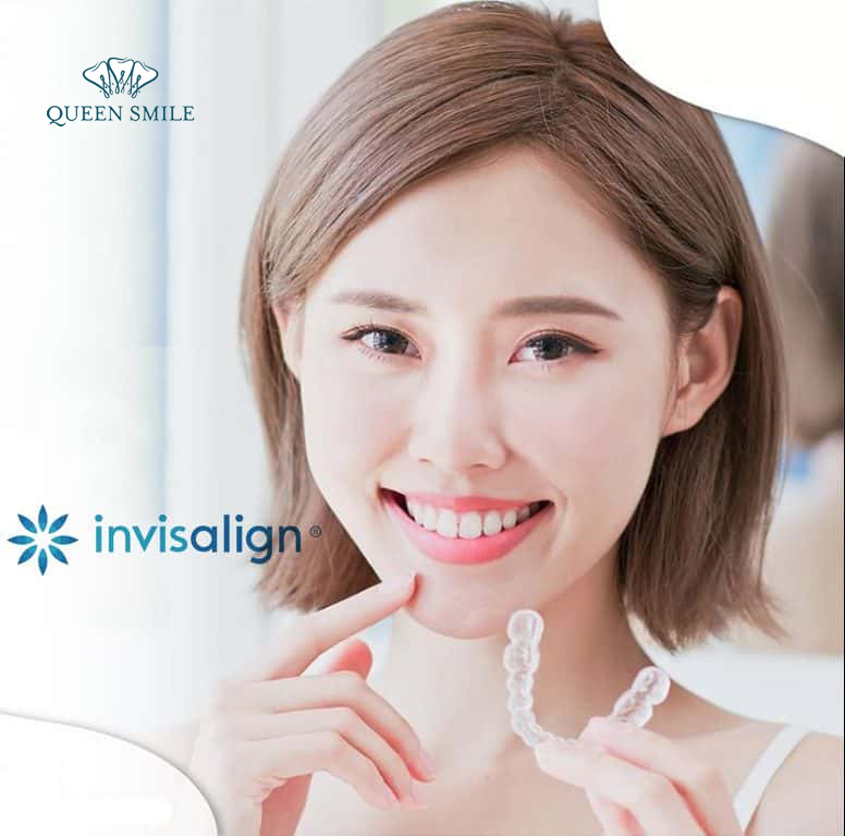 nieng-rang-trong-suot-invisalign