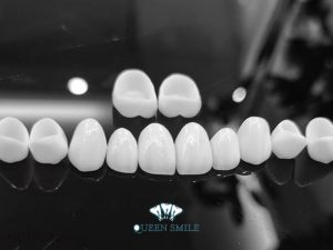 chi-phi-dan-su-veneer