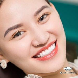 boc-rang-su-ht-smile-gia-bao-nhieu