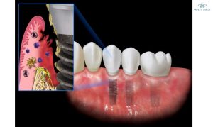 bien-chung-khi-trong-rang-implant