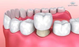 lay-tuy-boc-rang-su-gia-bao-nhieu