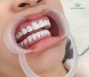 gia-boc-rang-su-2-ham