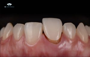 boc-rang-su-bi-ho-chan-rang-phai-lam-sao-1