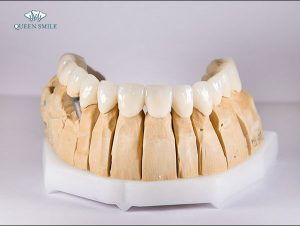 rang-su-ceramill