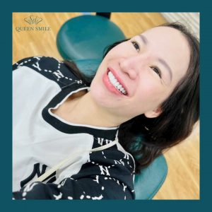 rang-su-cercon-ht-gia-bao-nhieu